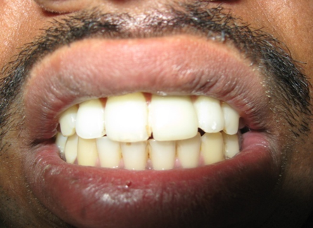 Final smile outcome after ceramic laminate
