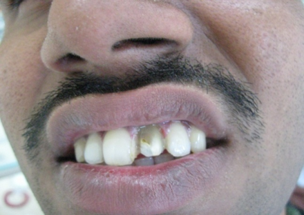 Pre treatment dental condition view 2